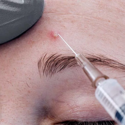 Corticosteroid injection for scar