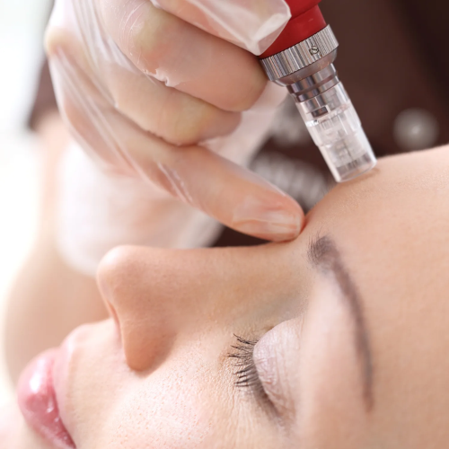 Micro needling treatment