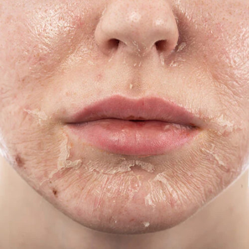 Chemical peel treatment