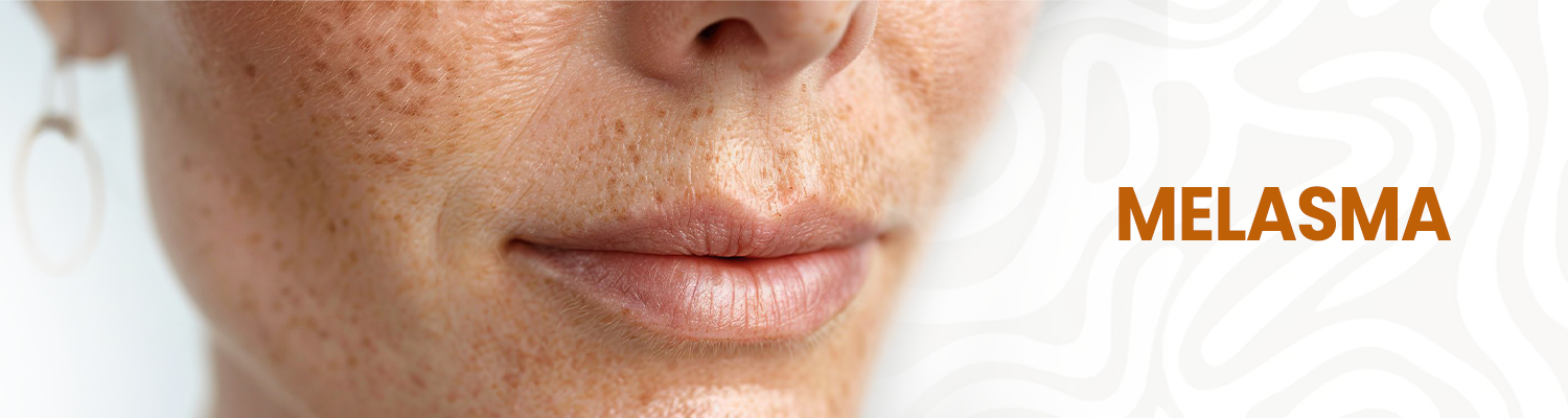 Melasma