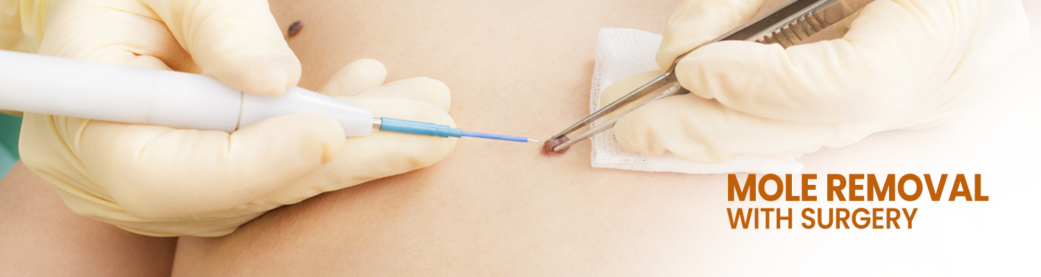 Mole Removal With Surgery
