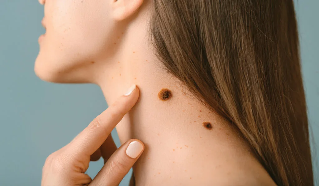 Lump removal procedure at First Scar Clinic